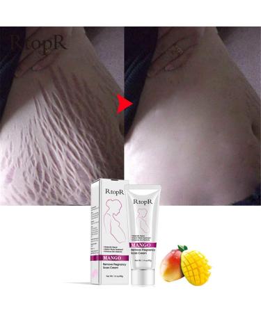 40G Remove Pregnancy Scars Scars and Acne Treatments for Pregnancy - Buy Online on GoSupps.com
