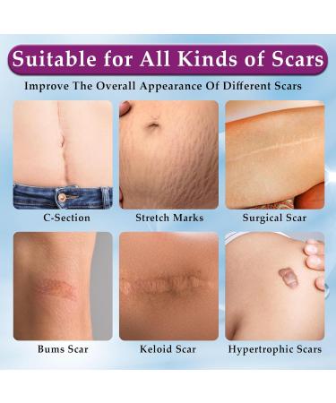 Eveellyn Scar Cream 1.7 oz - Professional Gel for Surgical, Stretch Mark, Keloid, C-Section, Burn, Acne & Old/New Scars Removal - Buy Online on GoSupps.com