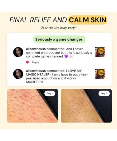 Complete Flare Care | Universal Essential Oil Free Flare & Thyme & Tea Tree Flare Care | Dual Relief for HS, Eczema, Diaper Rash, Impetigo, Cystic Acne, Ingrown hair | Drawing Salve (2 x 1oz) - Buy Online on GoSupps.com