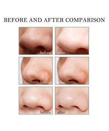 Effective Blackhead Remover Mask & Nose Strips for Clear Skin | International Shipping - Buy Online on GoSupps.com