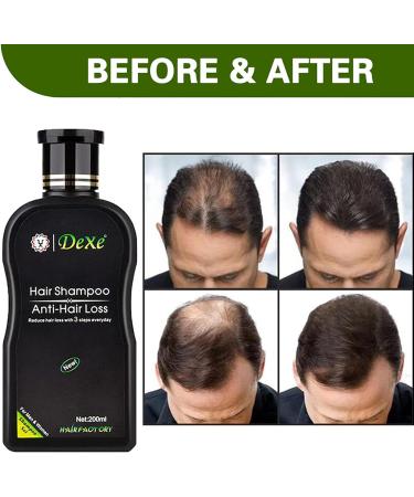 Hair Growth Shampoo Anti-Hair Loss Shampoo Shampoo for Thinning Hair and Hair Loss Strong Natural Organic Ingredients Repairs Damaged Scalp - Buy Online on GoSupps.com