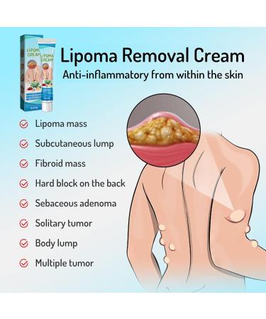 Garner Skin Lump-Free Lipoma Removal Ointment - Natural Vegetable Formula for Clump Removal, Anti-Swelling, Body Care - 1pc - Buy Online on GoSupps.com