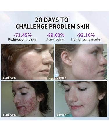 RF Radio Skin Tightening Machine w/ Red LED Therapy - Anti-Aging & Dark Circle Reduction for Face, Neck, Belly & Thighs - Buy Online on GoSupps.com