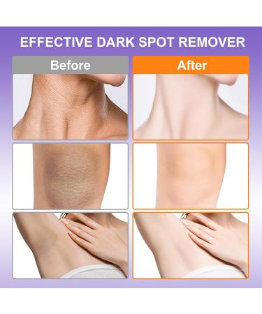 Dark Spot Corrector Cream for Body - Effective Dark Spot Remover for Intimate Areas Underarms Knees & Elbows - 2 fl oz - Buy Online on GoSupps.com
