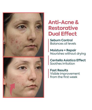 Clasy Care Acne Cream for Face Spot Treatment for Pimples & Acne Scars Salicylic Acid & Niacinamide for Scar Removal Teen & Adult Skincare with Zinc PCA - Buy Online on GoSupps.com