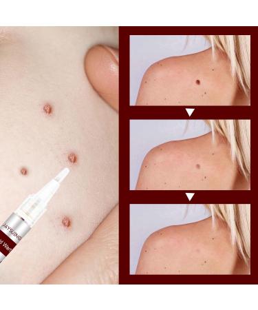 Wipe Off Tags & Moles Remover Fast Easy Effective Quick & Safe Remove Skin Tags Moles Remover Pen 1/2/3/5 PCS - Buy Online on GoSupps.com