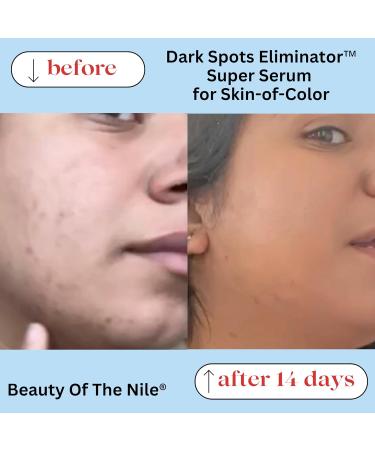 Dark Spots Eliminator Serum | Hyperpigmentation Age & Acne Treatment for Skin of Color | Beauty of the Nile - 1 Oz - Buy Online on GoSupps.com