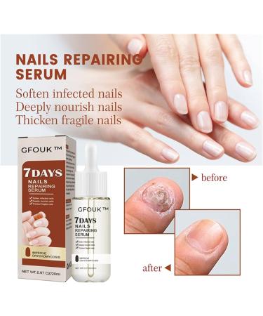 7 Days Of Nail Growth And Strengthening Essence 3PCs 20ml Nail Repair Essence Color Changing Nails Nails Quickly Grow And Repair Damaged Nail Polish - Buy Online on GoSupps.com
