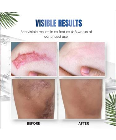 NUANYOYO Silvive Advanced Silicone Scar Removal Gel - Reduces Old & New Scars (1 Bottle) - Buy Online on GoSupps.com