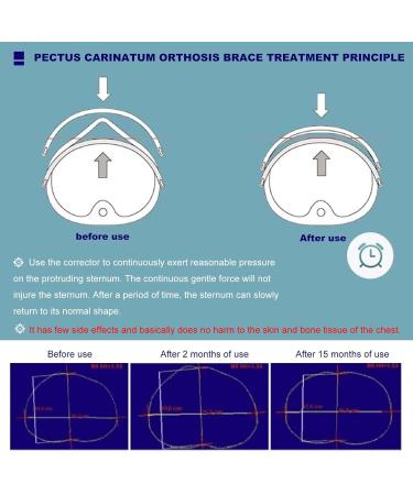 SUZLAZYR Pectus Carinatum Orthosis Brace Thoracic Depression Brace Pigeon Chest Support Medical Ribs Valgus Orthosis Braces Comfortable and Breathable S - Buy Online on GoSupps.com