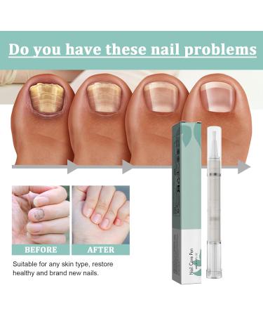 VKaoess Mullend Nail Care Pen 3in1 nail repair serum strengthens and repairs damaged toenails with tea tree oil nail hardener and whitener effective serum to repair toenails 5 pieces - Buy Online on GoSupps.com