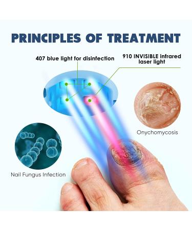 Blue Nail Fungus Laser Treatment Device- Clip-on Design, Targets Damaged Toenails - Buy Online on GoSupps.com