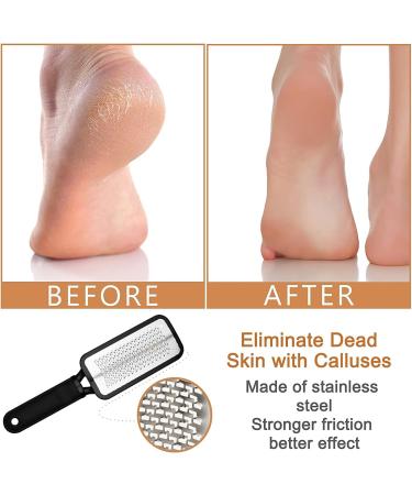 Best Fro e Files: Corneal Remover Pedicure Tool for Wet & Dry Feet - Ultimate Foot Care Solution - Buy Online on GoSupps.com