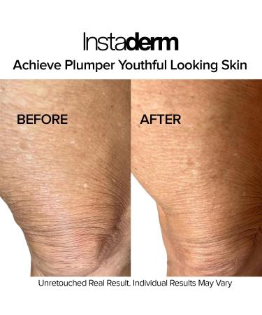 Instaderm Crepe Fix Body Restorative Cream Anti-Aging Wrinkle Cream Support Skins Natural Elastin & Collagen Production to Restore Lift Tighten Hydrate & Smooth Thinning Aged Crepey Skin. 4OZ - Buy Online on GoSupps.com
