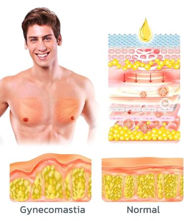 Chestdefy Gynecomastia Reduction Massage Oil & Tightening Cream for Men | Effective Breast Reduction Solution (1PCS) - Buy Online on GoSupps.com