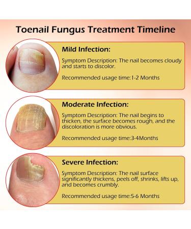 Recuren Plus Extra Strength Toenail Fungus Treatment Nail Repair for Damaged Cracked Discolored Nails Tea Tree Formula for Fast Fungus Removal & Growth Strengthener - 1.01 Fl Oz - Buy Online on GoSupps.com