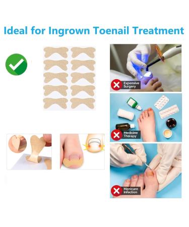 Ingrown Toenail Treatment - 100Pcs Breathable Corrector Patches & Strips | Pain-Free Nail Correction Durable Light Brown Stickers for Effective Ingrown Nail Care - Buy Online on GoSupps.com