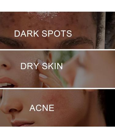 Dark Spot Remover for Face and Body Freckle Removel Cream Pigmentation Removal Melasma Cream Dark Spot Corrector Dark Spot Remover for Face Age Spot Remover for Face Dark Age Spot Remover - Buy Online on GoSupps.com
