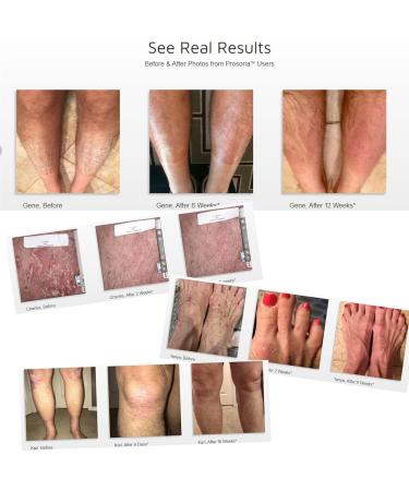 Prosoria Treatment System Double Kit 2oz | Powerful Psoriasis Relief with Salicylic Acid Turmeric Shea Butter & Vitamins | Gel & Ointment for Scaling Flaking Dryness Itching & Redness Relief Treatment Kit 4 Ounce - Buy Online on GoSupps.com