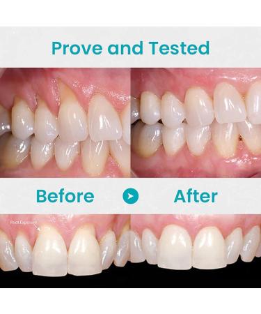 Neslemy Gum Gel Neslemy Gum Shield Therapy Gel Dentizen Gum Therapy Gel Gum Instant Treatment Gel Teeth Whitening Essence Pen Intensive Stain Removal Teeth (3 Pcs) - Buy Online on GoSupps.com