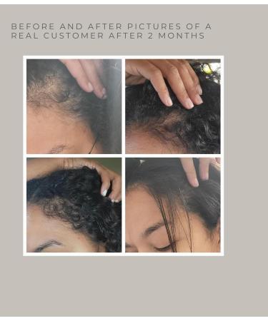 TRESSCURE DHT Blocker Hair Growth Serum | Fuller Thicker Hair in 90 Days | No Oily Residue | International Shipping Available - Buy Online on GoSupps.com