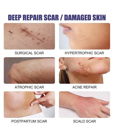 Invisible Silicone Scar Sheets | Promotes Circulation | Surgical & Caesarean Scar Removal Strips - Buy Online on GoSupps.com