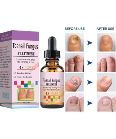Fungal Nail Treatment - Toe Nail Fungal Treatment - Nail Fungus Treatment for Toenail and Fingernails - Anti fungus Nail Repair and Strengthen Fix & Renew Damaged Broken Nails - Buy Online on GoSupps.com