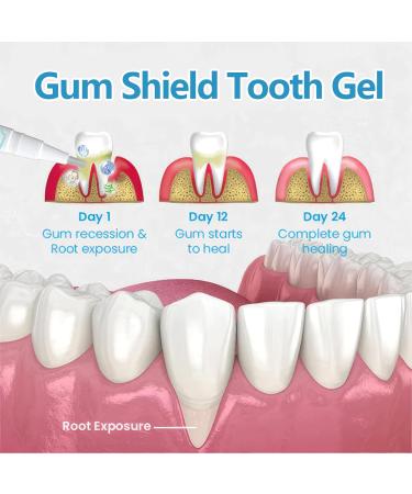 Gum Treatment Gel Gum Disease Treatment Pen Sports Gum Shield Treatment Gel Teeth Whitening Cleansing Essence Pen Powerful Teeth Stain Remover (4 pcs) - Buy Online on GoSupps.com