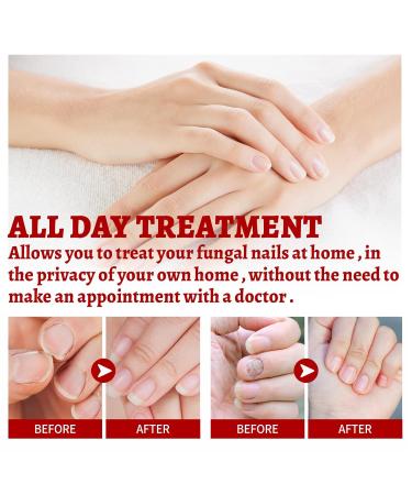 Foot Corn Remover Gel - Effective Foot Corn Removal Treatment for Cracked, Dead Dry Skin - Fits All Foot Sizes (3 pcs) - Buy Online on GoSupps.com