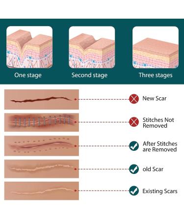 Silicone Scar Sheets - Professional Tape for Surgical Scars | C-Section, Burn, Keloid, Acne | 16 Pads (5.9 x 1.6) - Scar Removal Strips - Buy Online on GoSupps.com