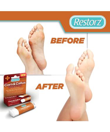 Restorz Corn and Callus Remover Stick with Salicylic Acid | Gentle & Fast-Acting Treatment for Skin Hands Feet Toes | Portable & Travel Size Ointment Applicator (1 Pack) - Buy Online on GoSupps.com