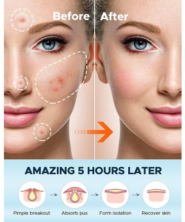 LitBear Acne Pimple Spot Patches - 80 Count Hydrocolloid Treatment for Face, Chin, Body with Tea Tree & Calendula Oil - Large Zit Breakouts Relief - Buy Online on GoSupps.com