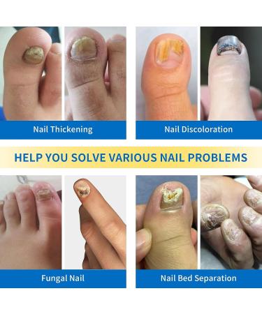 Nail Fungus Laser Treatment Device - Blue Light Therapy for Onychomycosis - Home Use for Toenail and Fingernail Treatment - Buy Online on GoSupps.com