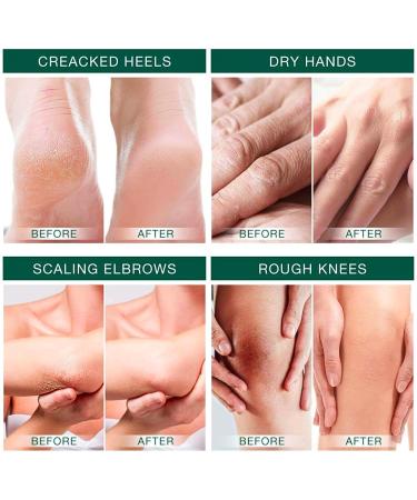 Urea 42% Foot Cream Cracked Heel Repair Cream Urea Foot Cream for Cracked Heels and Dry skin Urea Cream for Feet with Tea Tree & Aloe Vera for Deep Moisturizing Callus Remover Gel and Soften 100g - Buy Online on GoSupps.com