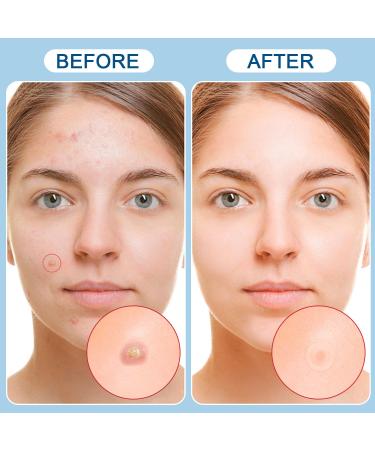 Invisible Pimple Patches - 110 Ultra Thin Hydrocolloid Acne Dots for Daytime Use - Effective Whitehead Treatment - Buy Online on GoSupps.com