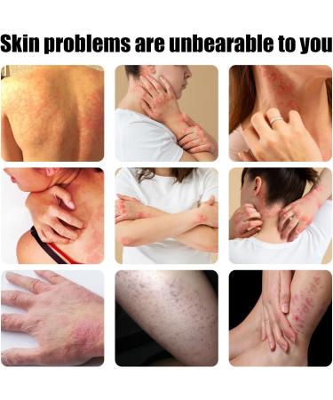 Antifungal Cream:Jock Itch Cream Soothing Eczema Relief Cream All-Natural Soothing Care & Fast Relief of Jock Itch Eczema Psoriasis - Ringworm Treatment for Humans - for Adults and Kids - Buy Online on GoSupps.com