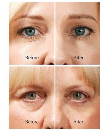 ROX Eye Lifting - TV Rox Anti Eye Wrinkle Booster | International Shipping Available - Buy Online on GoSupps.com