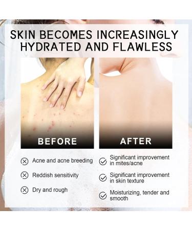 Acne Treatment Spary Back Acne Body Wash Aloe Soap for Face & Body Acne Marks Skin Care Spray Body Moisturiser For Acne Shoulder &Back Acne Reduce Back Acne& Nourishing-(Anti Acne Spray+Aloe Soap) - Buy Online on GoSupps.com