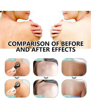 Back Acne Treatment Spray Acne Treatment Spray Acne Moisturiser for Back Body Body Acne Treatment Acne Back Treatment Back Spray Acne Body Acne Spray Back Acne Treatment Acne Body Spray 120ml - Buy Online on GoSupps.com