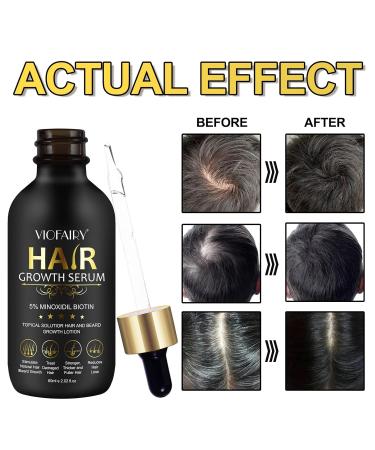 5% Minoxidil Hair Growth Serum for Men & Women | Biotin Hair Regrowth Treatment | Thicker Fuller Healthier Hair - 2.02oz - Buy Online on GoSupps.com