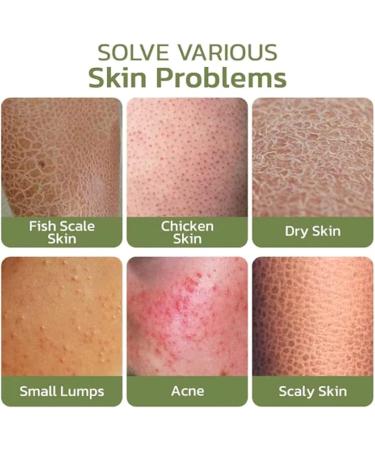 DUBUSH Keratosis Hair Cream Hair Follicle Repair Cream Chicken Skin Smoothing Cream Keratosis Hair Treatment Cream for Rough and Dented Skin - Buy Online on GoSupps.com