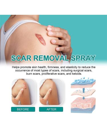 BLEDD Medical Grade Scar Spray - Advanced Scar Removal Treatment for Gentle Skin Care - 2pcs - Buy Online on GoSupps.com