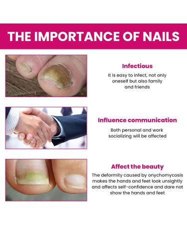 Strengthener for Damaged Nails Versatile Repair Care 10ml Cuticle Repair Oil - Yellow Foot and Nail Care - Ingrown Toenail Prevention - Men and Women - Buy Online on GoSupps.com