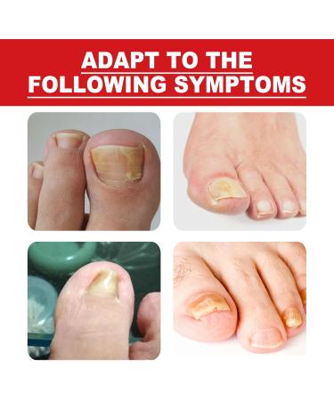  TQEBWUS Nail and Toenail Strengthening Liquid - 10ml Ingrown Toenail Corrector Drops Beauty Care for Hands and Feet Nighttime Travel Treatment for Dry Damaged Cracked Curved Fragile and Chipped Nails - Buy Online on GoSupps.com