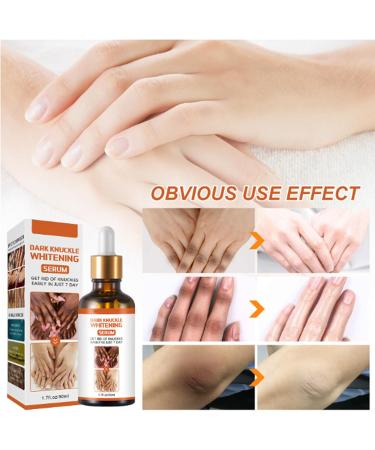 Dark Knuckles Remover From Hand Dark Spot Correcting Glow Serum Lightweight Body Oil Whitening Serum Hyperpigmentation Dark Spot Remover For Hand & Foot & Body Brightening Body Oil For Darkness 1pc - Buy Online on GoSupps.com