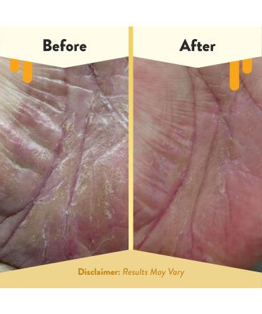 ECZEMA HONEY Brown Sugar Scrub - Natural Face & Body Exfoliator for Dry Skin Gentle Eczema Relief 6 Oz - Ideal Body Care for Sensitive Skin - Unisex Skin Care - Buy Online on GoSupps.com