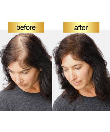 Hair Fiber for Thinning Hair & Bald Spots - Natural Hair Building Fibers Instantly Thicker Hair (Medium Brown) - 25g | Ideal for Men & Women - Buy Online on GoSupps.com