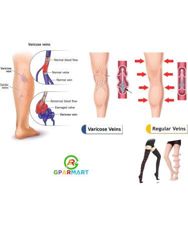 GPAR Premium Medical Compression Stockings Class 2 | Unisex Thigh-High 23-32 mmHg for Varicose Veins Edema & Leg Pain | XL Beige - Buy Online on GoSupps.com