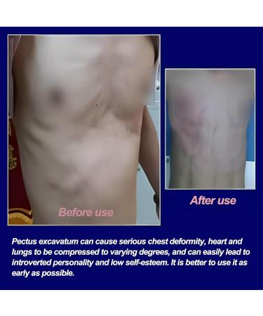 Pectus Excavatum Orthosis Brace-Vacuum Bell Pectus Excavatum-Sternal Depression Support-for All Ages(S) - Buy Online on GoSupps.com