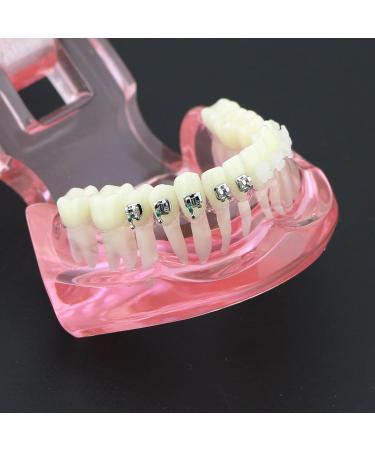 Buy Dental Orthodontic Teeth Model with Metal & Ceramic Brackets - Ideal for Study & Research | International Shipping Available - Buy Online on GoSupps.com